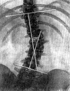 Claw.ru | Рефераты по физкультуре и спорту | Сколиоз
